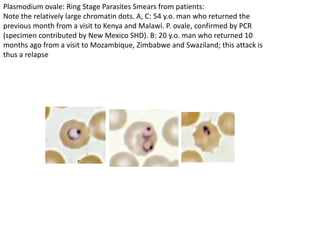 Plasmodium ovale: Ring Stage Parasites Smears from patients:
Note the relatively large chromatin dots. A, C: 54 y.o. man who returned the
previous month from a visit to Kenya and Malawi. P. ovale, confirmed by PCR
(specimen contributed by New Mexico SHD). B: 20 y.o. man who returned 10
months ago from a visit to Mozambique, Zimbabwe and Swaziland; this attack is
thus a relapse
 