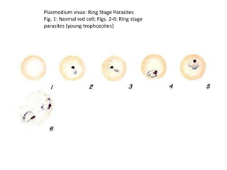 Plasmodium vivax: Ring Stage Parasites
Fig. 1: Normal red cell; Figs. 2-6: Ring stage
parasites (young trophozoites)
 