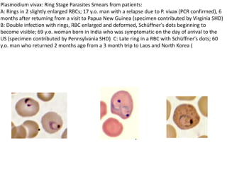 Plasmodium vivax: Ring Stage Parasites Smears from patients:
A: Rings in 2 slightly enlarged RBCs; 17 y.o. man with a relapse due to P. vivax (PCR confirmed), 6
months after returning from a visit to Papua New Guinea (specimen contributed by Virginia SHD)
B: Double infection with rings, RBC enlarged and deformed, Schüffner's dots beginning to
become visible; 69 y.o. woman born in India who was symptomatic on the day of arrival to the
US (specimen contributed by Pennsylvania SHD) C: Late ring in a RBC with Schüffner's dots; 60
y.o. man who returned 2 months ago from a 3 month trip to Laos and North Korea (
 