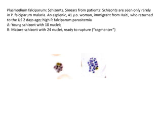 Plasmodium falciparum: Schizonts. Smears from patients: Schizonts are seen only rarely
in P. falciparum malaria. An asplenic, 41 y.o. woman, immigrant from Haiti, who returned
to the US 2 days ago; high P. falciparum parasitemia
A: Young schizont with 10 nuclei;
B: Mature schizont with 24 nuclei, ready to rupture (“segmenter”)
 