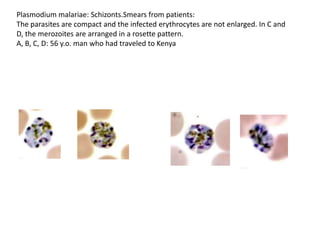 Plasmodium malariae: Schizonts.Smears from patients:
The parasites are compact and the infected erythrocytes are not enlarged. In C and
D, the merozoites are arranged in a rosette pattern.
A, B, C, D: 56 y.o. man who had traveled to Kenya
 