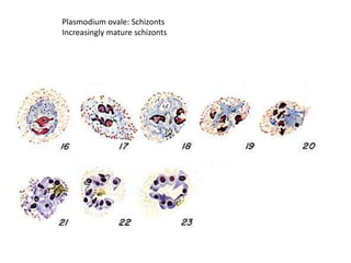 Plasmodium ovale: Schizonts
Increasingly mature schizonts
 