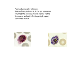 Plasmodium ovale: Schizonts
Smears from patients: A, B: 54 y.o. man who
returned the previous month from a visit to
Kenya and Malawi. Infection with P. ovale,
confirmed by PCR
 