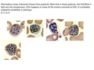 Plasmodium vivax: Schizonts Smears from patients: Note that in these patients, the Schüffner's
dots are not conspicuous. (This happens in many of the smears received at CDC; it is probably
related to variability in staining.)
A, C, D, E:
 