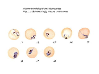 Plasmodium falciparum: Trophozoites
Figs. 11-18: Increasingly mature trophozoites
 