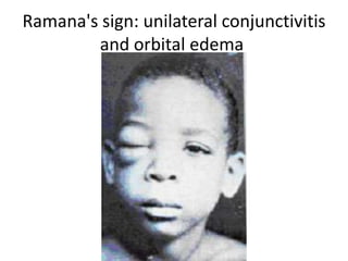 Ramana's sign: unilateral conjunctivitis
and orbital edema
 