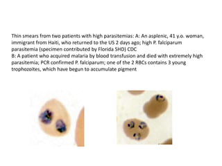 Thin smears from two patients with high parasitemias: A: An asplenic, 41 y.o. woman,
immigrant from Haiti, who returned to the US 2 days ago; high P. falciparum
parasitemia (specimen contributed by Florida SHD) CDC
B: A patient who acquired malaria by blood transfusion and died with extremely high
parasitemia; PCR confirmed P. falciparum; one of the 2 RBCs contains 3 young
trophozoites, which have begun to accumulate pigment
 