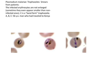 Plasmodium malariae: Trophozoites Smears
from patients:
The infected erythrocytes are not enlarged
(sometime they even appear smaller than non-
infected ones). C is a "band form" trophozoite.
A, B, C: 56 y.o. man who had traveled to Kenya
 