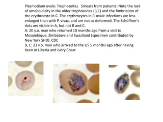 Plasmodium ovale: Trophozoites Smears from patients: Note the lack
of ameboidicity in the older trophozoites (B,C) and the fimbriation of
the erythrocyte in C. The erythrocytes in P. ovale infections are less
enlarged than with P. vivax, and are not as deformed. The Schüffner's
dots are visible in A, but not B and C.
A: 20 y.o. man who returned 10 months ago from a visit to
Mozambique, Zimbabwe and Swaziland (specimen contributed by
New York SHD). CDC
B, C: 23 y.o. man who arrived to the US 5 months ago after having
been in Liberia and Ivory Coast
 
