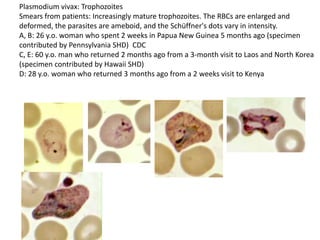 Plasmodium vivax: Trophozoites
Smears from patients: Increasingly mature trophozoites. The RBCs are enlarged and
deformed, the parasites are ameboid, and the Schüffner's dots vary in intensity.
A, B: 26 y.o. woman who spent 2 weeks in Papua New Guinea 5 months ago (specimen
contributed by Pennsylvania SHD) CDC
C, E: 60 y.o. man who returned 2 months ago from a 3-month visit to Laos and North Korea
(specimen contributed by Hawaii SHD)
D: 28 y.o. woman who returned 3 months ago from a 2 weeks visit to Kenya
 
