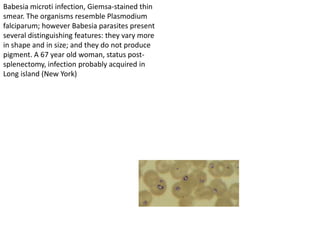 Babesia microti infection, Giemsa-stained thin
smear. The organisms resemble Plasmodium
falciparum; however Babesia parasites present
several distinguishing features: they vary more
in shape and in size; and they do not produce
pigment. A 67 year old woman, status post-
splenectomy, infection probably acquired in
Long island (New York)
 