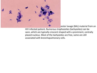 Toxoplasma gondii in the bronchoalveolar lavage (BAL) material from an
HIV infected patient. Numerous trophozoites (tachyzoites) can be
seen, which are typically crescent shaped with a prominent, centrally
placed nucleus. Most of the tachyzoites are free, some are still
associated with bronchopulmonary cells.
 