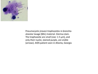 Pneumocystis jiroveci trophozoites in broncho-
alveolar lavage (BAL) material. Giemsa stain.
The trophozoite are small (size: 1-5 µm), and
only their nuclei, stained purple, are visible
(arrows). AIDS patient seen in Atlanta, Georgia
 