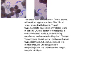 Two areas from a blood smear from a patient
with African trypanosomiasis. Thin blood
smear stained with Giemsa. Typical
trypomastigote stages (the only stages found
in patients), with a posterior kinetoplast, a
centrally located nucleus, an undulating
membrane, and an anterior flagellum. The two
Trypanosoma brucei species that cause human
trypanosomiasis, T. b. gambiense and T. b.
rhodesiense, are undistinguishable
morphologically. The trypanosomes length
range is 14-33 µm
 