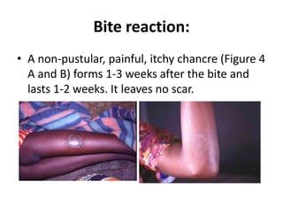 Bite reaction:
• A non-pustular, painful, itchy chancre (Figure 4
A and B) forms 1-3 weeks after the bite and
lasts 1-2 weeks. It leaves no scar.
 