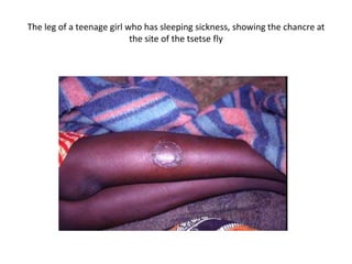 The leg of a teenage girl who has sleeping sickness, showing the chancre at
the site of the tsetse fly
 
