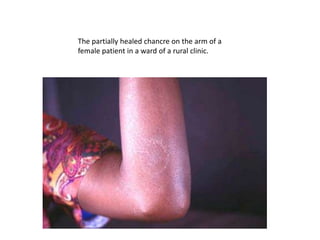 The partially healed chancre on the arm of a
female patient in a ward of a rural clinic.
 