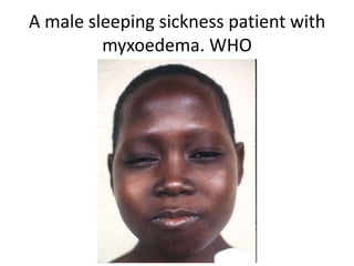 A male sleeping sickness patient with
myxoedema. WHO
 