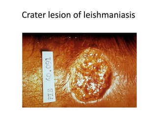 Crater lesion of leishmaniasis
 