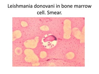 Leishmania donovani in bone marrow
cell. Smear.
 