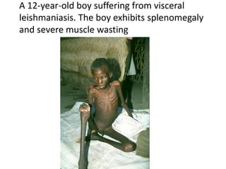 A 12-year-old boy suffering from visceral
leishmaniasis. The boy exhibits splenomegaly
and severe muscle wasting
 