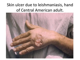 Skin ulcer due to leishmaniasis, hand
of Central American adult.
 