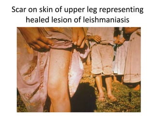 Scar on skin of upper leg representing
healed lesion of leishmaniasis
 