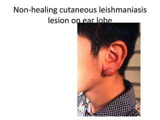 Non-healing cutaneous leishmaniasis
lesion on ear lobe
 