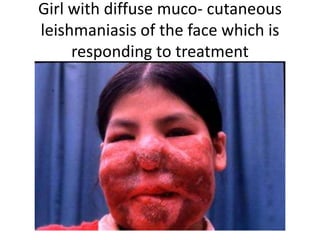 Girl with diffuse muco- cutaneous
leishmaniasis of the face which is
responding to treatment
 