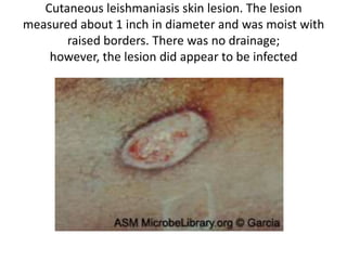 Cutaneous leishmaniasis skin lesion. The lesion
measured about 1 inch in diameter and was moist with
raised borders. There was no drainage;
however, the lesion did appear to be infected
 