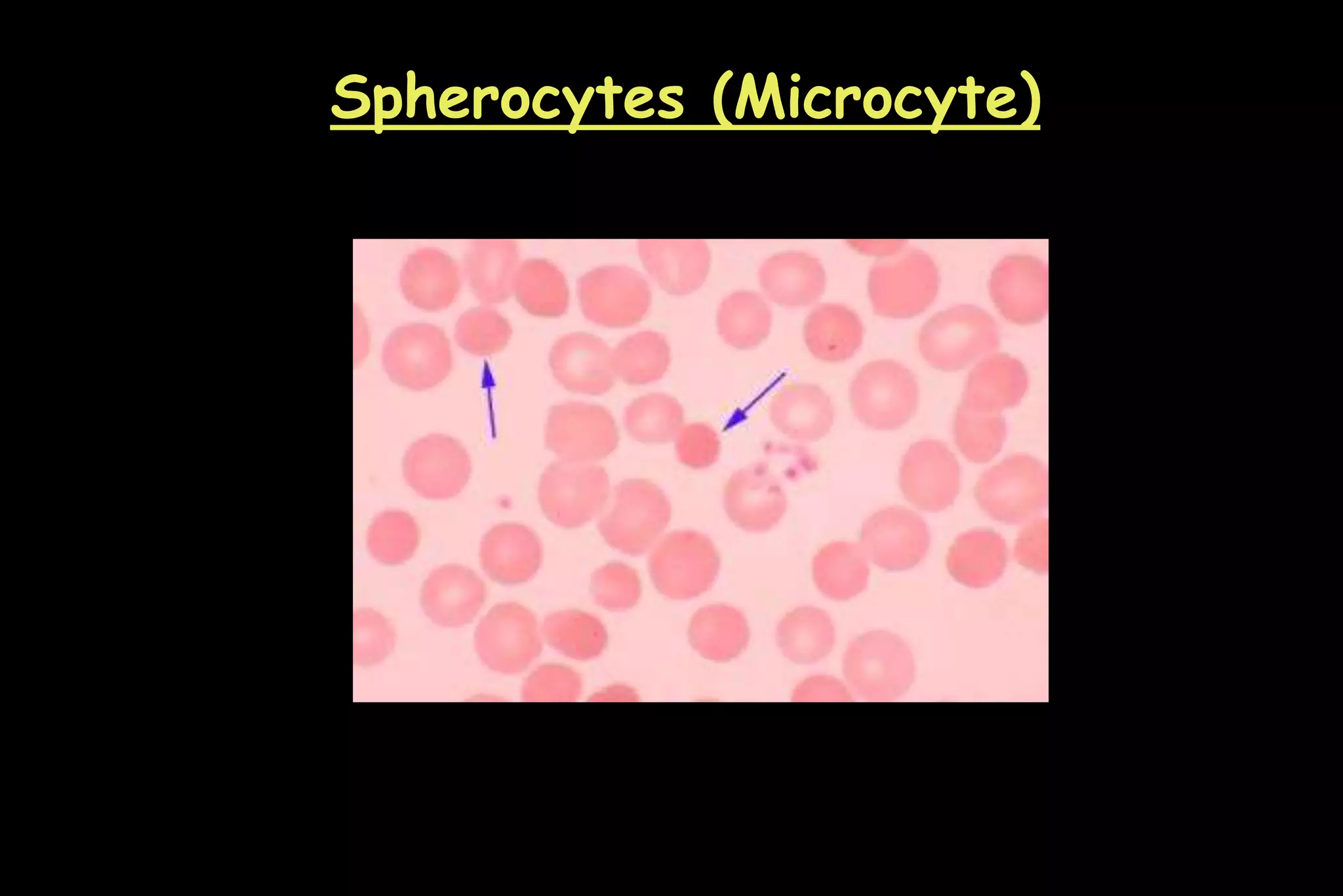 Spherocytes (Microcyte)
 