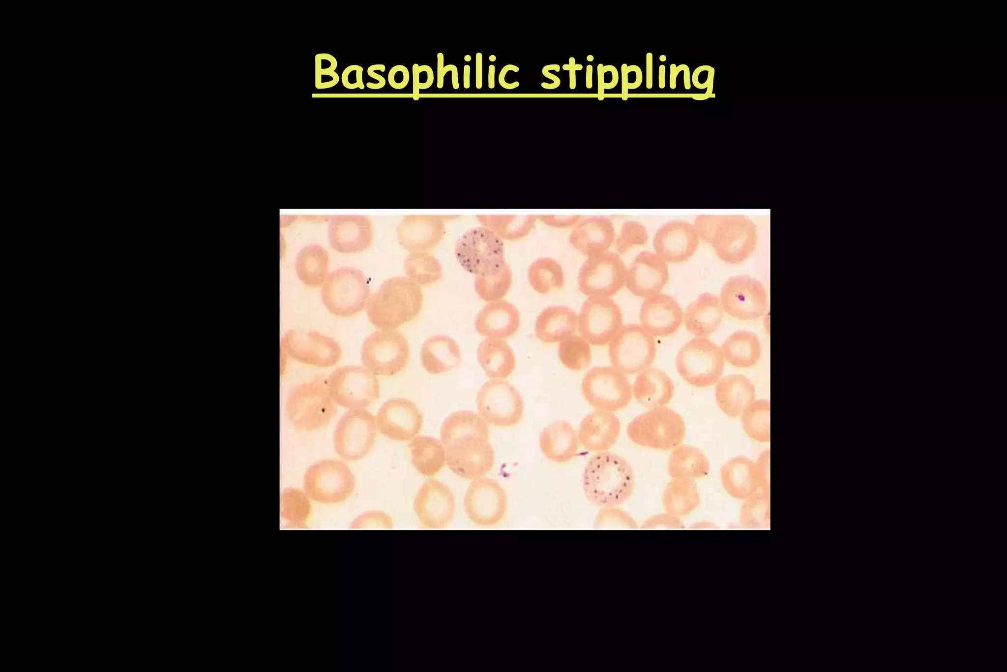 Basophilic stippling
 