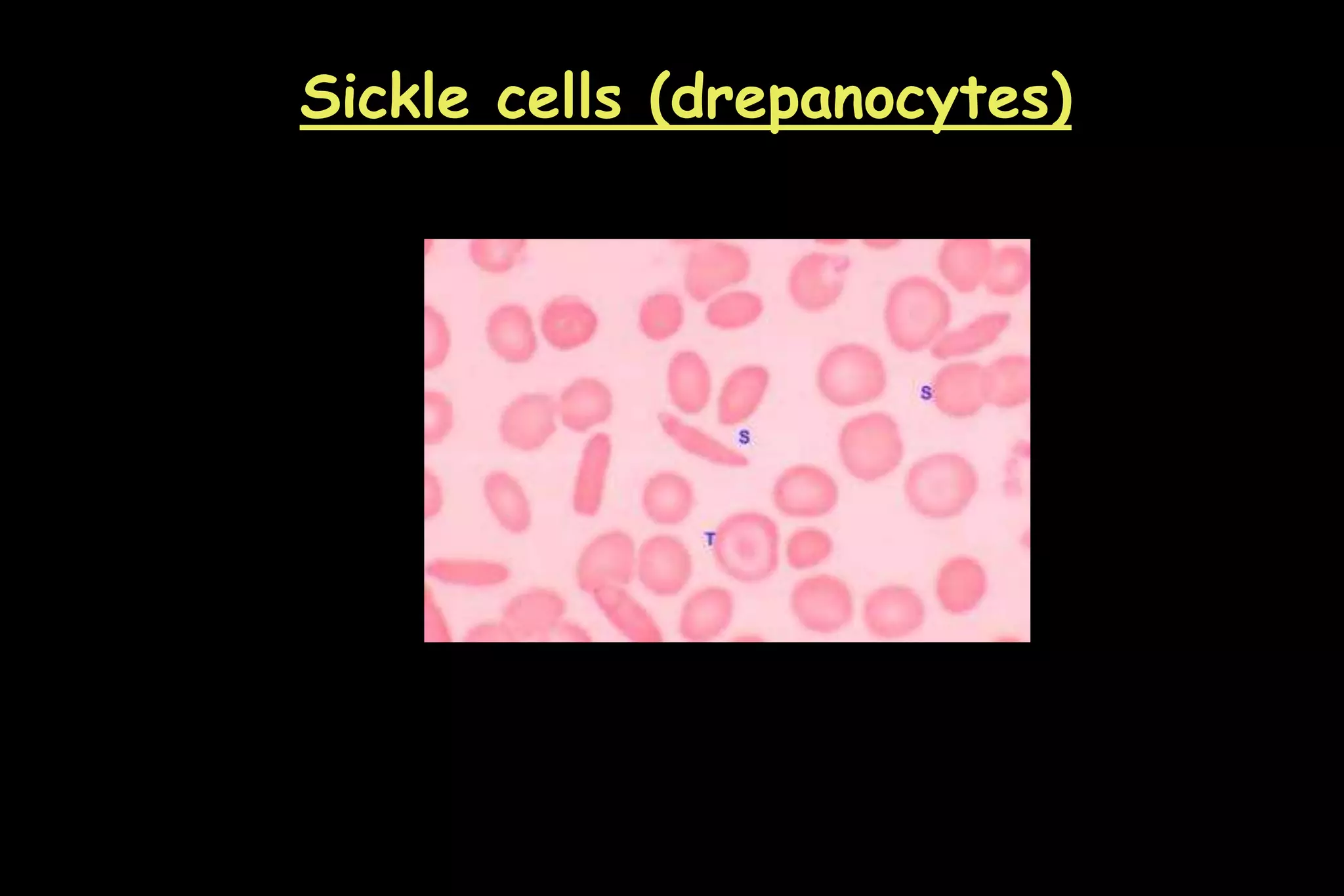 Sickle cells (drepanocytes)
 
