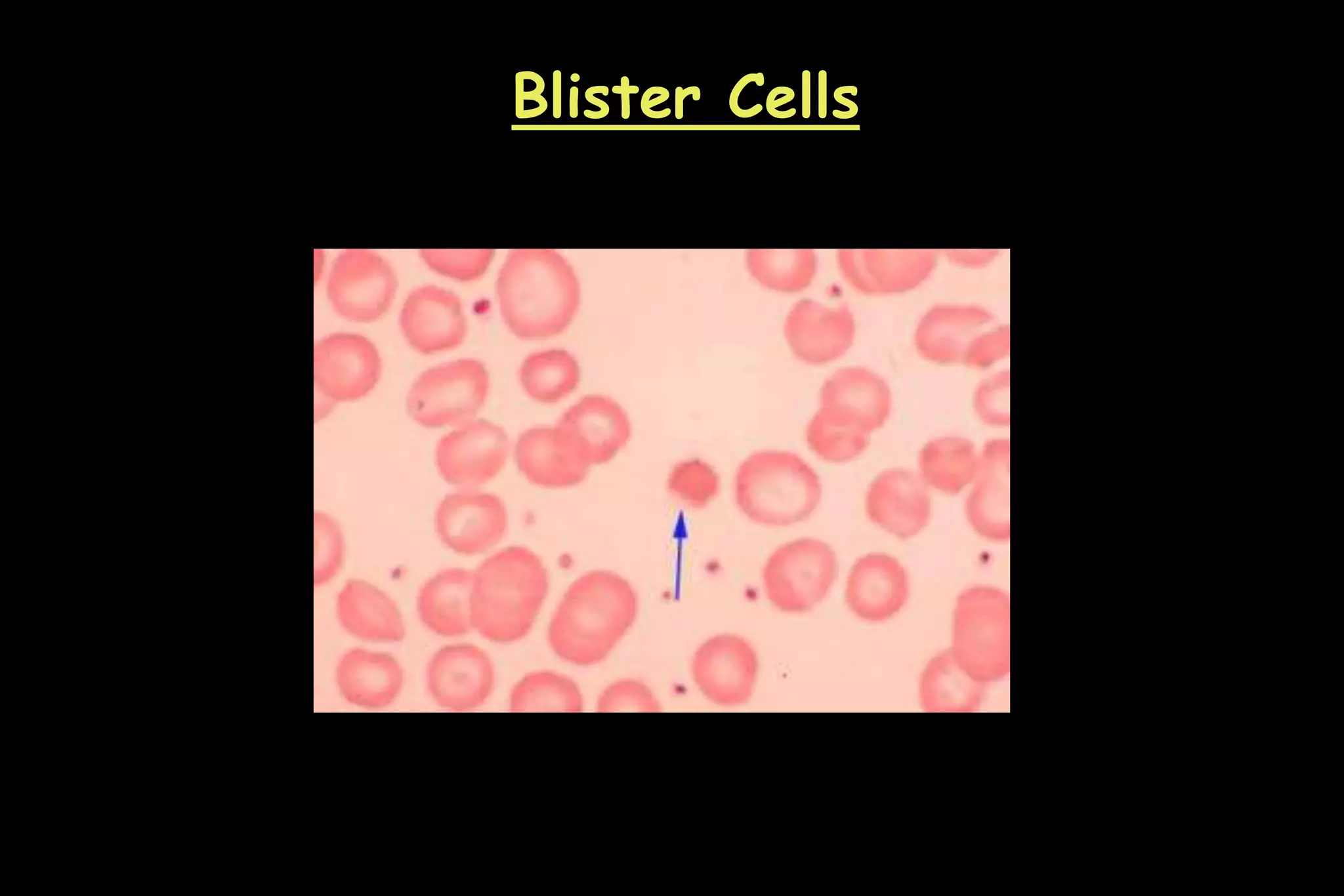 Blister Cells
 
