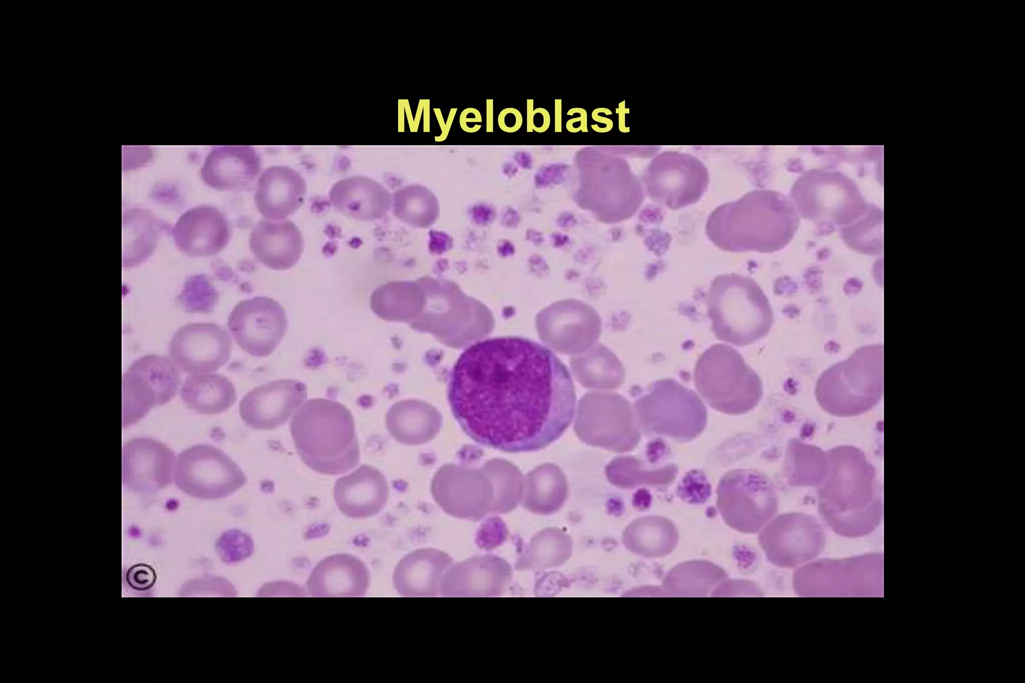 Myeloblast
 
