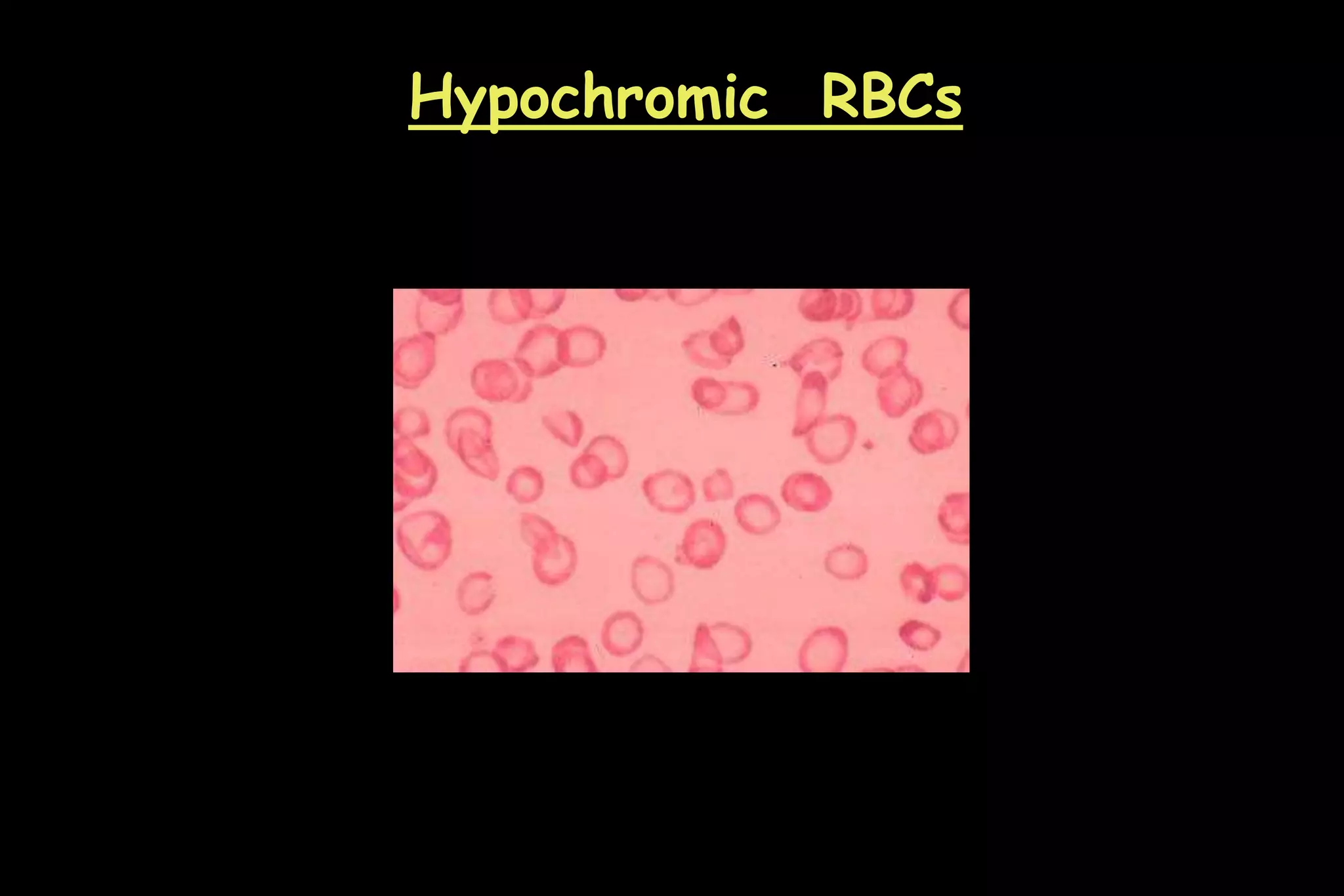 Hypochromic RBCs
 