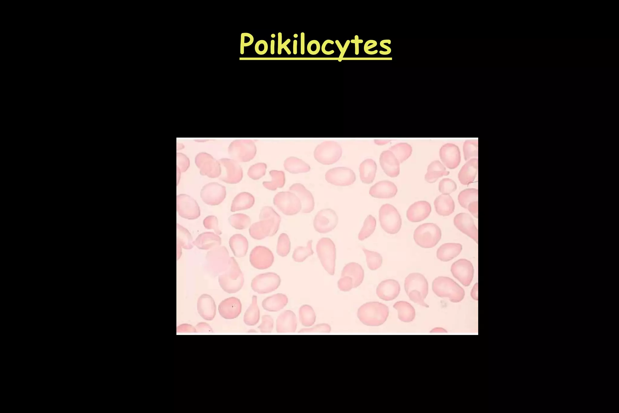 Poikilocytes
 