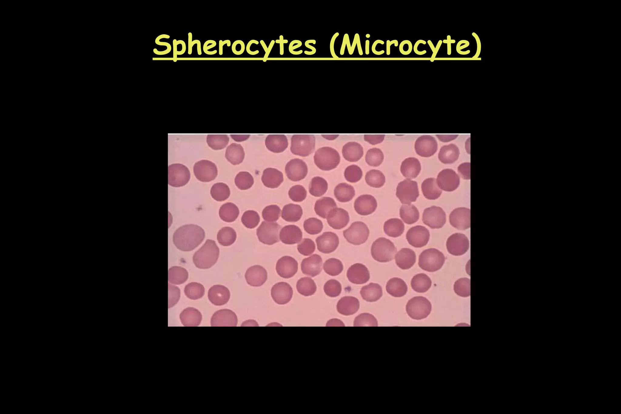 Spherocytes (Microcyte)
 