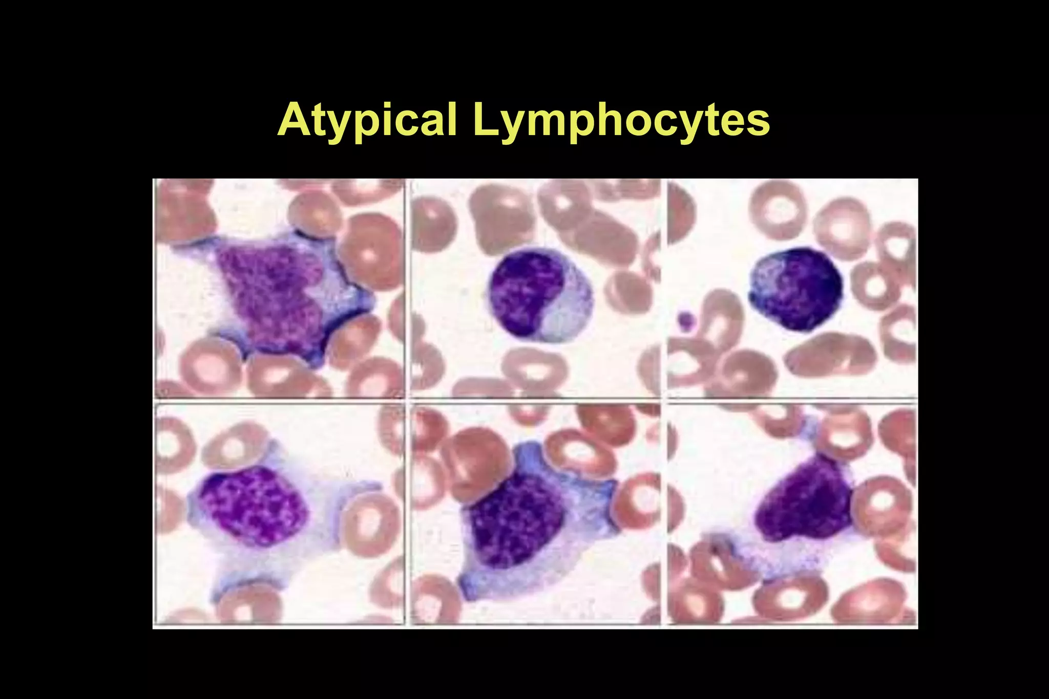Atypical Lymphocytes
 