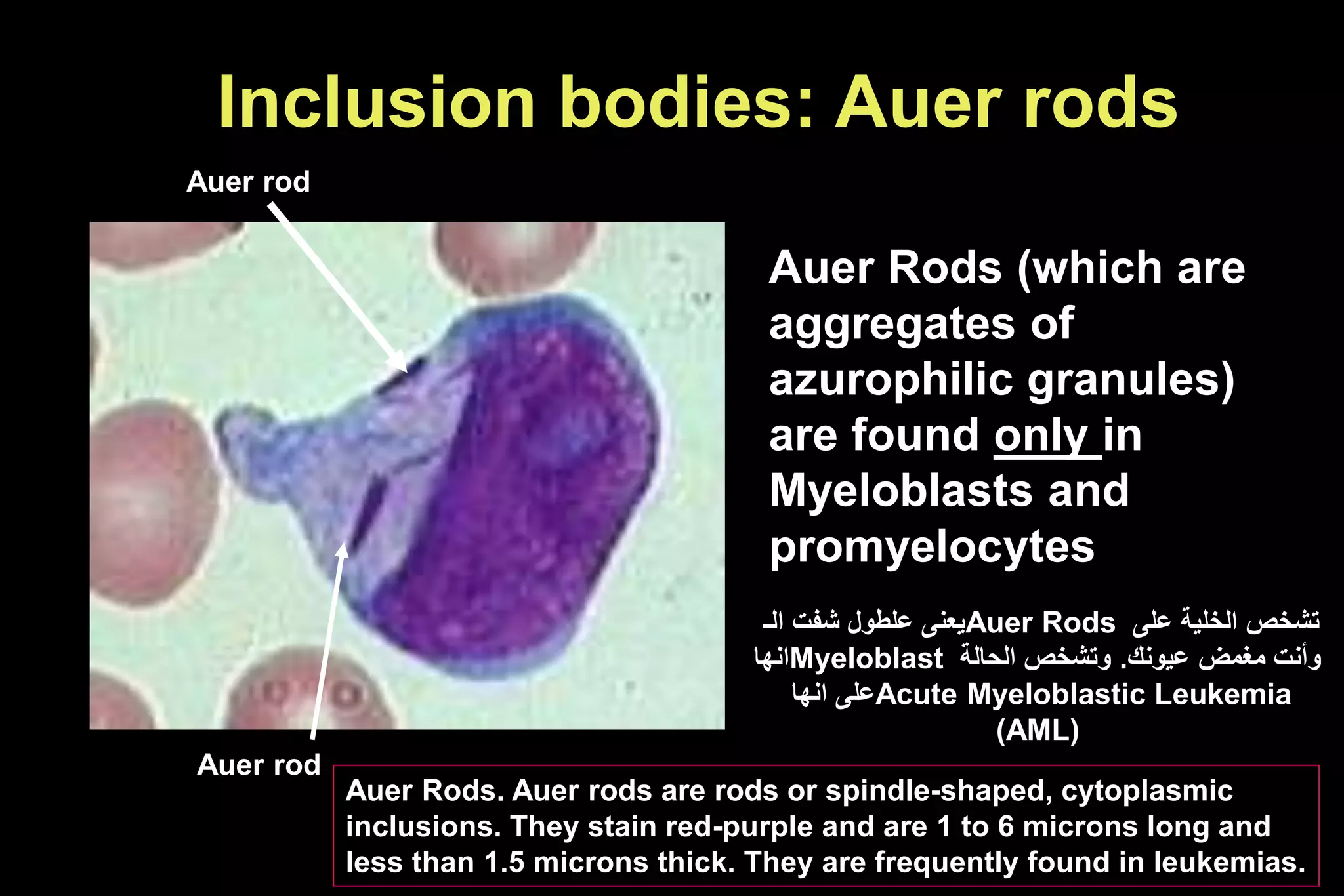 Inclusion bodies: Auer rods
Auer Rods (which are
aggregates of
azurophilic granules)
are found only in
Myeloblasts and
promyelocytes
‫الـ‬ ‫شفت‬ ‫علطول‬ ‫يعنى‬Auer Rods ‫على‬ ‫الخلية‬ ‫تشخص‬
‫انها‬Myeloblast ‫عيونك‬ ‫مغمض‬ ‫وأنت‬
.
‫الحالة‬ ‫وتشخص‬
‫انها‬ ‫على‬Acute Myeloblastic Leukemia
(AML)
Auer rod
Auer Rods. Auer rods are rods or spindle-shaped, cytoplasmic
inclusions. They stain red-purple and are 1 to 6 microns long and
less than 1.5 microns thick. They are frequently found in leukemias.
Auer rod
 