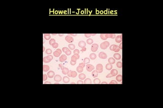 Howell-Jolly bodies
 