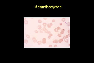 Acanthocytes
 
