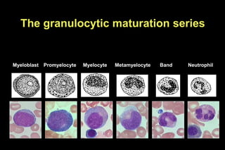 The granulocytic maturation series
Myeloblast Promyelocyte Myelocyte Metamyelocyte Band Neutrophil
 