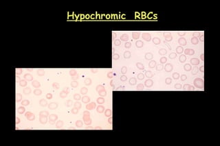 Hypochromic RBCs
 