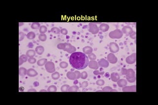 Myeloblast
 