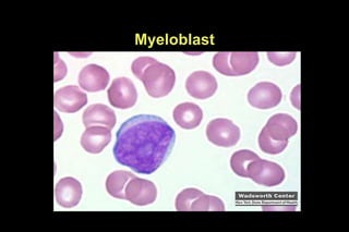 Myeloblast
 