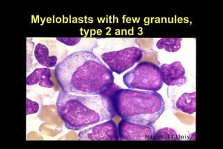Myeloblasts with few granules,
type 2 and 3
 
