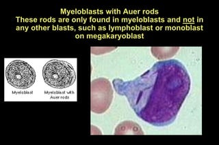 Myeloblasts with Auer rods
These rods are only found in myeloblasts and not in
any other blasts, such as lymphoblast or monoblast
on megakaryoblast
 