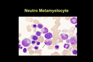 Neutro Metamyelocyte
 