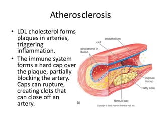 Atherosclerosis
• LDL cholesterol forms
plaques in arteries,
triggering
inflammation.
• The immune system
forms a hard cap over
the plaque, partially
blocking the artery.
Caps can rupture,
creating clots that
can close off an
artery.
 